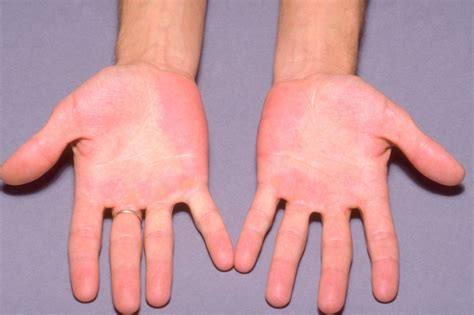 erythromelalgia pictures|hot arms symptoms.